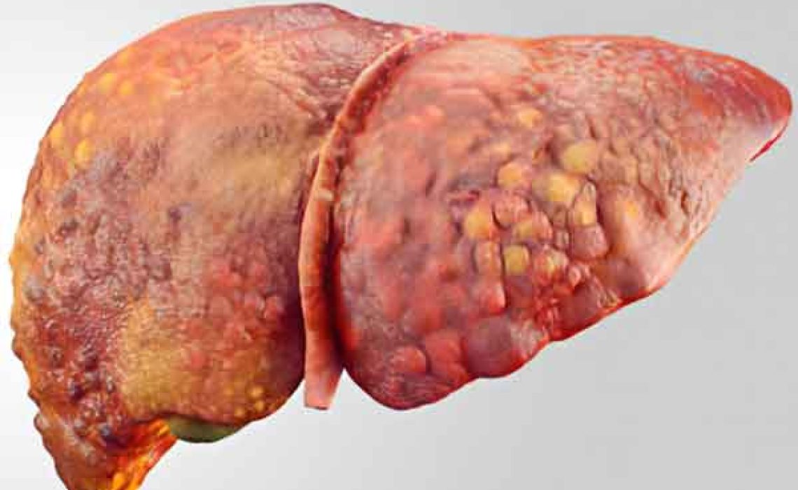 درمان سرطان کبد